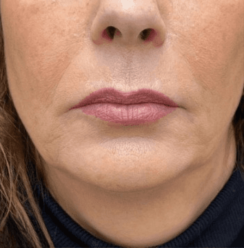 After anti-ageing treatment