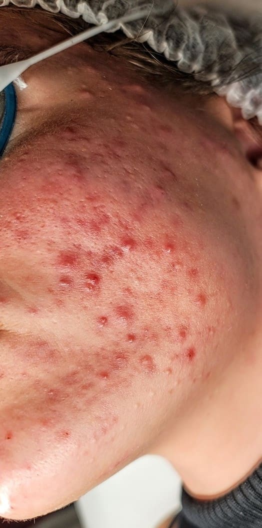 Before - Active acne clearance