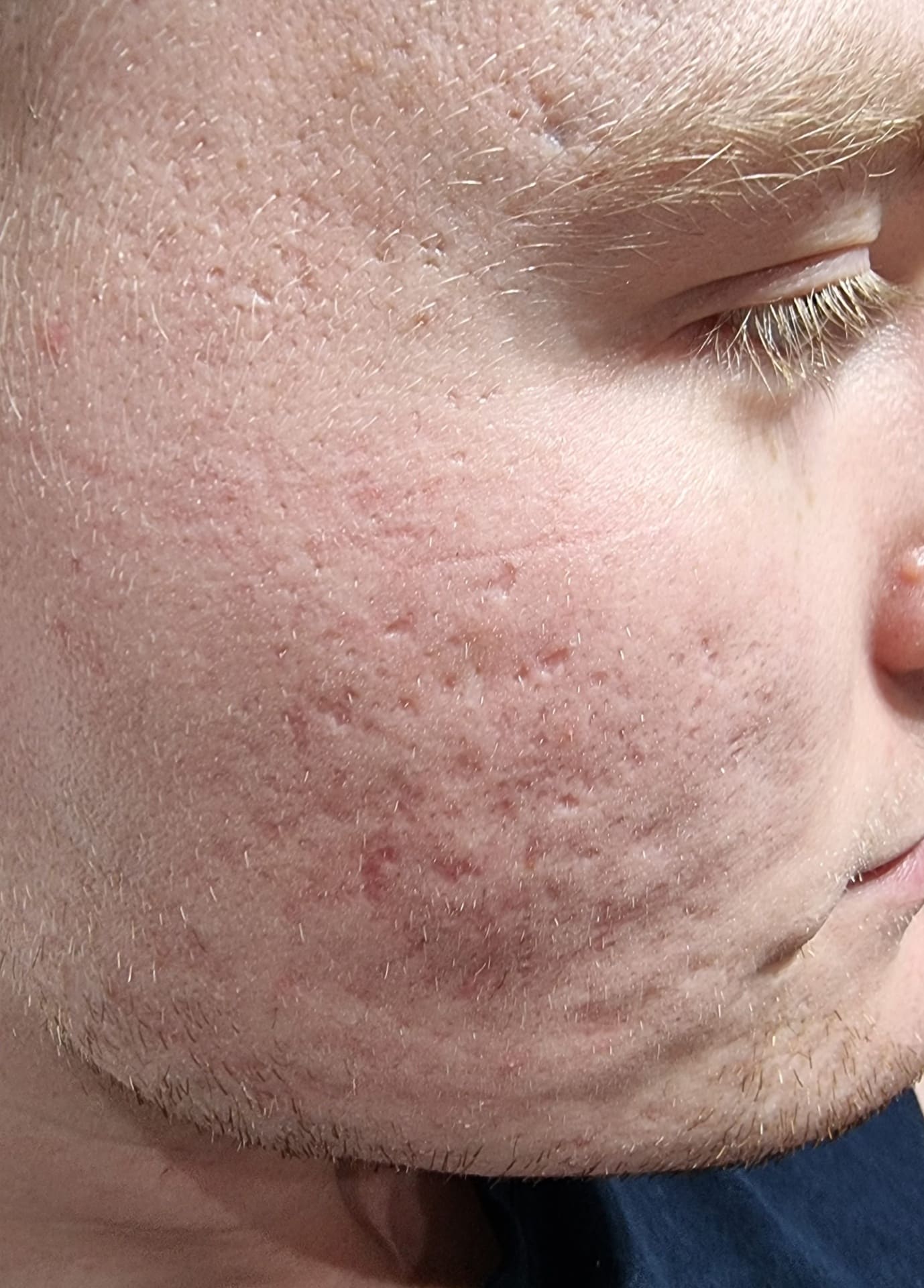 Before - Acne scars and texture