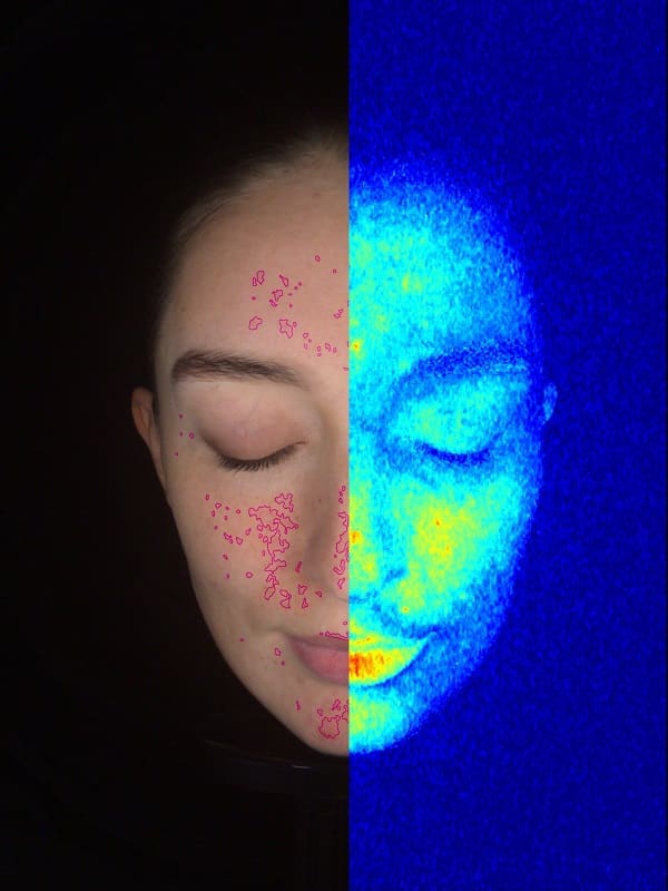 MEICET skin analysis heat map