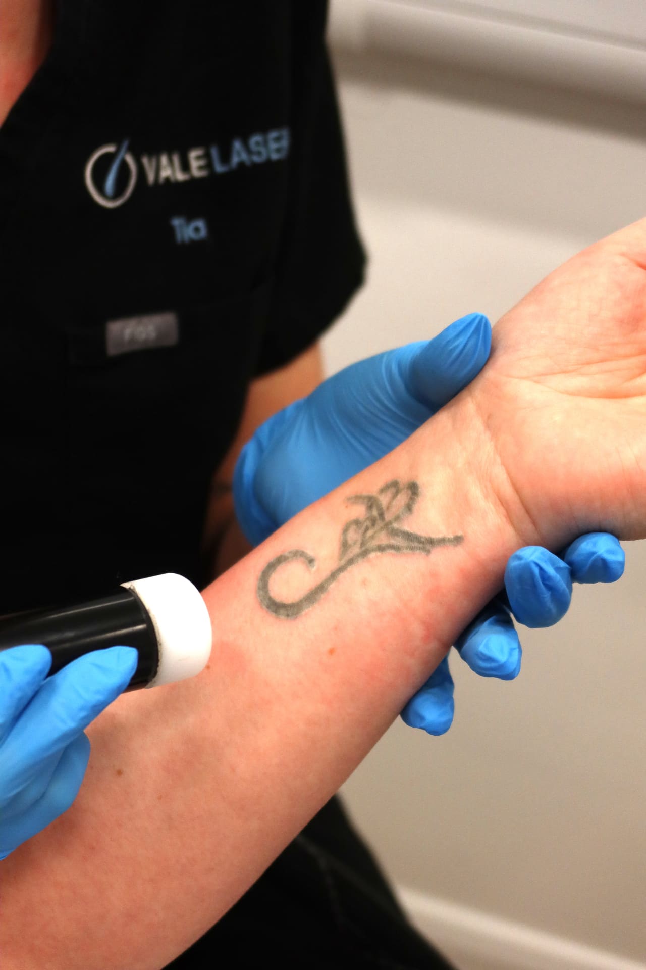 Medical-grade laser equipment for tattoo removal